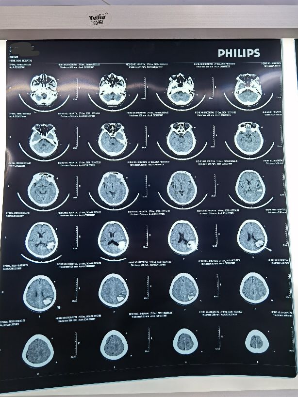 硬脑膜外血肿引流,高压氧治疗颅内出血