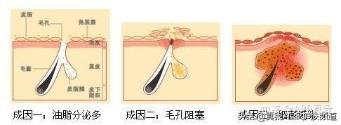 去痘印产品终极盘点，这几款效果肉眼可见！网友：价格效果成正比