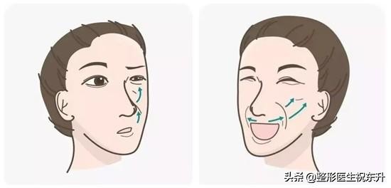 做了很多次医美法令纹还去不掉,法令纹的印子是不是去不掉了