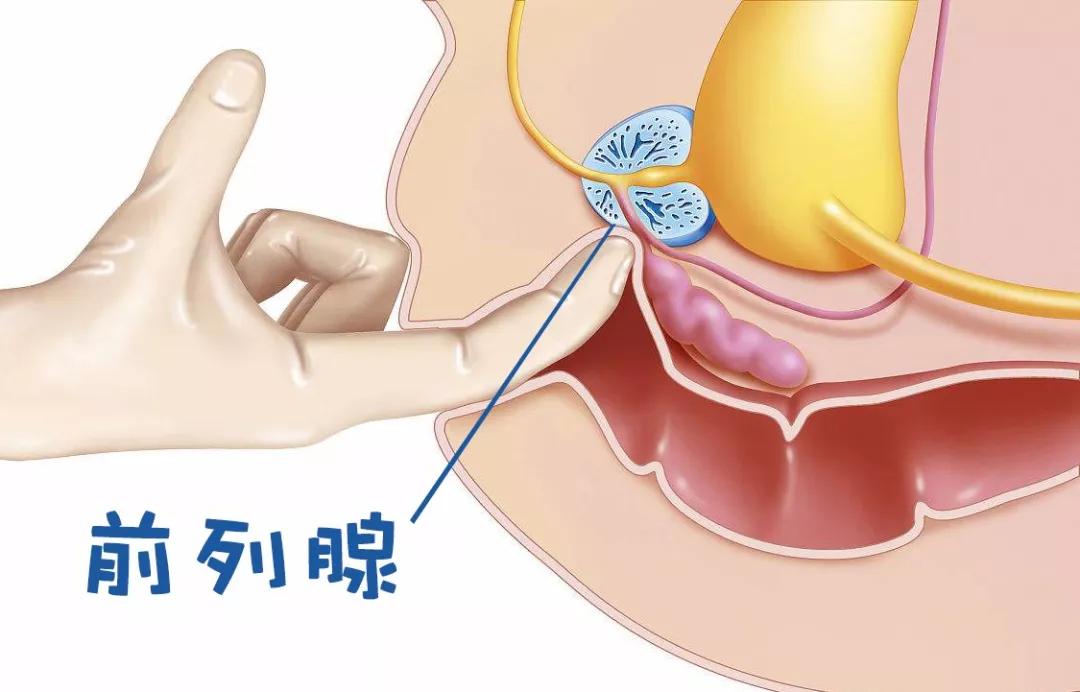 前列腺癌病人最后的病情,前列腺癌怎样养生