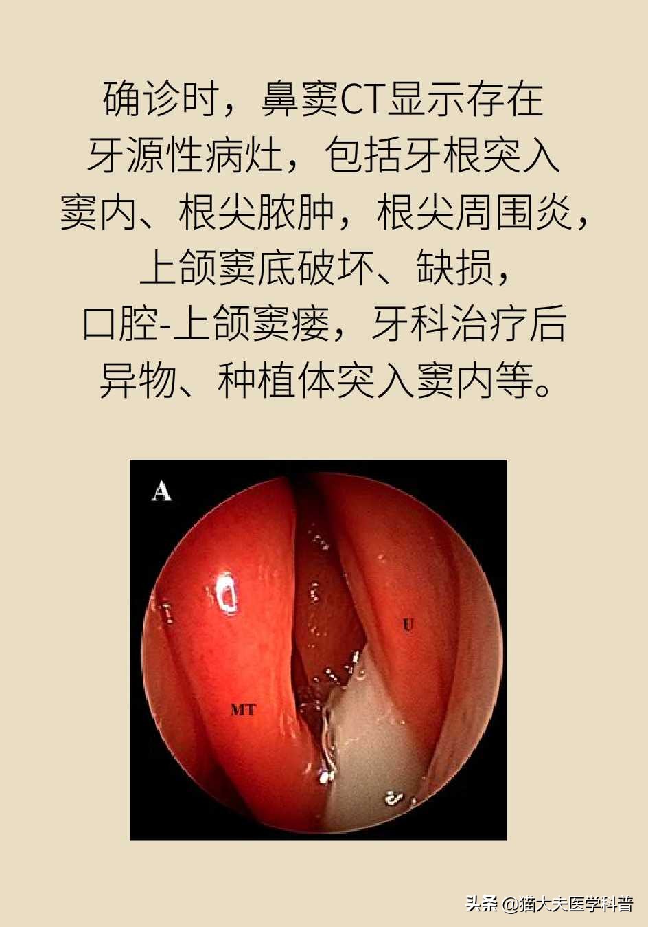 鼻窦炎引起的牙龈肿痛,牙龈引起的鼻窦炎怎么治疗