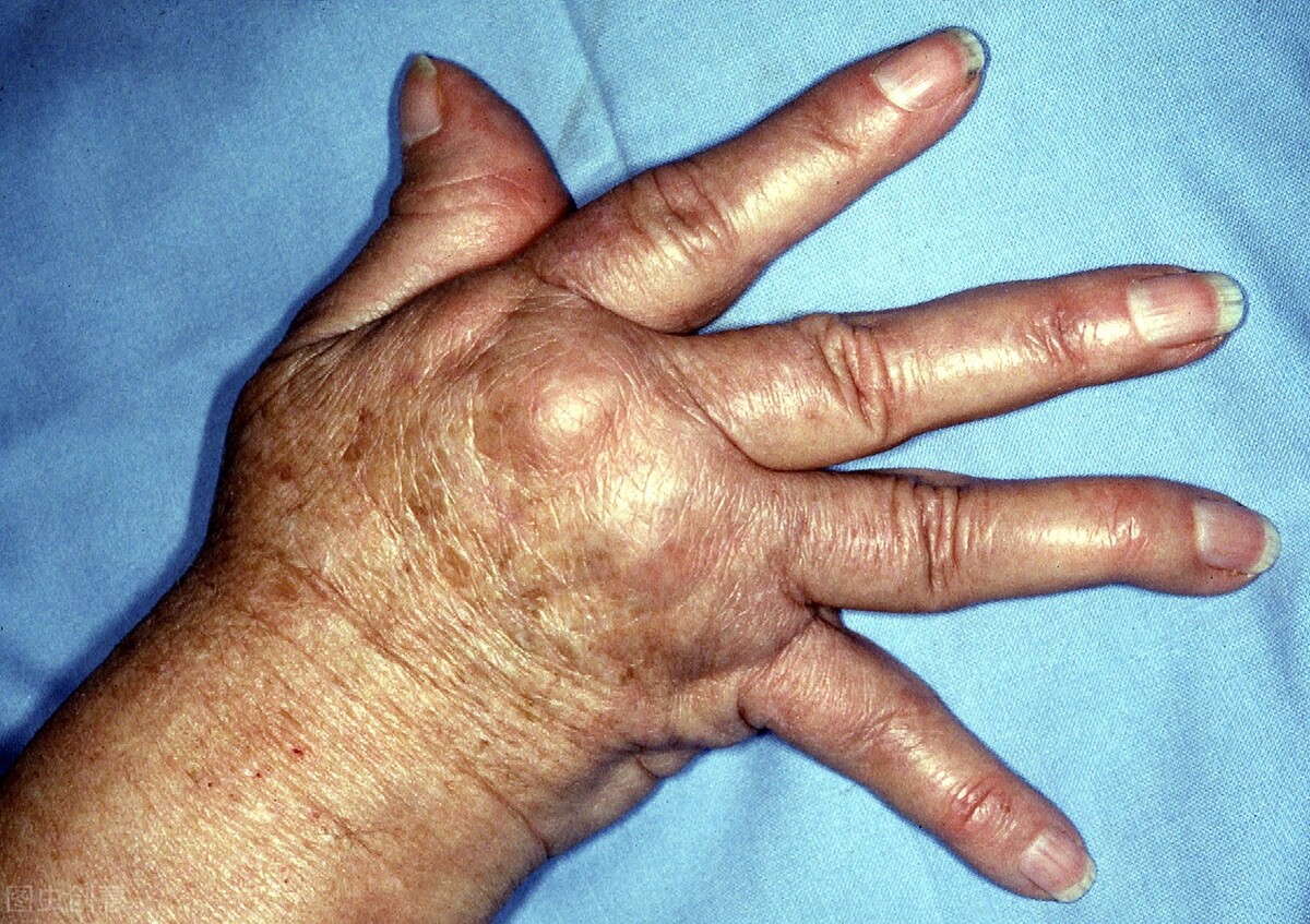 风湿病怎么治疗才可以彻底治好,风湿病怎么才能治好呢