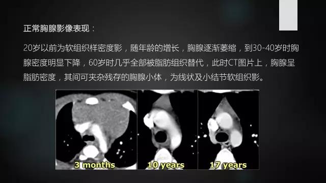 前上纵隔高密度影考虑胸腺未退化,肺纵隔胸腺结节12mm看什么科