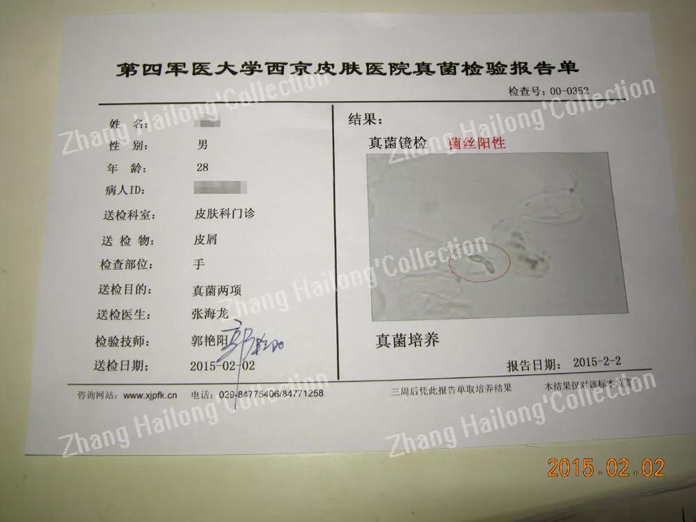 孩子脸上长癣怎么办,孩子脸上长癣是怎么回事啊