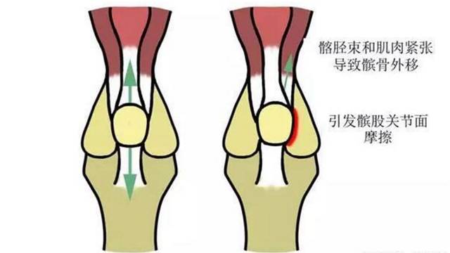 膝关节咔咔响隐隐作痛,下蹲时膝关节有小咔咔声