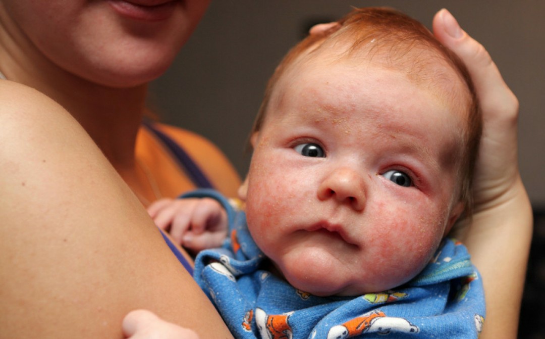 湿疹反复发作怎么用药,宝宝湿疹反复不好中药治疗