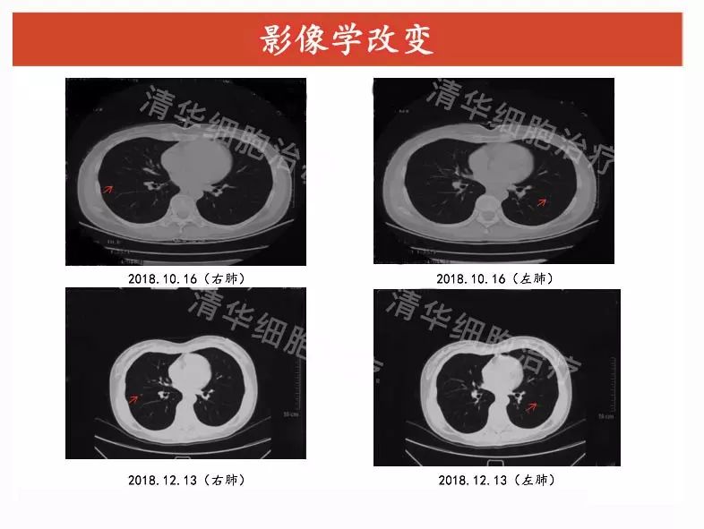卵巢癌术后需要几次化疗,卵巢癌先化疗三次再手术效果好吗