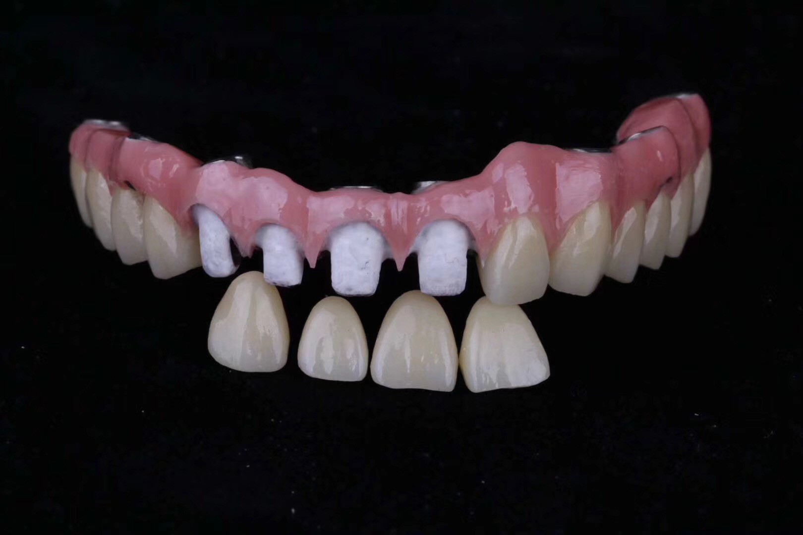 已经有牙洞了怎么根管治疗,牙髓腐烂坏死再做根管治疗会痛吗