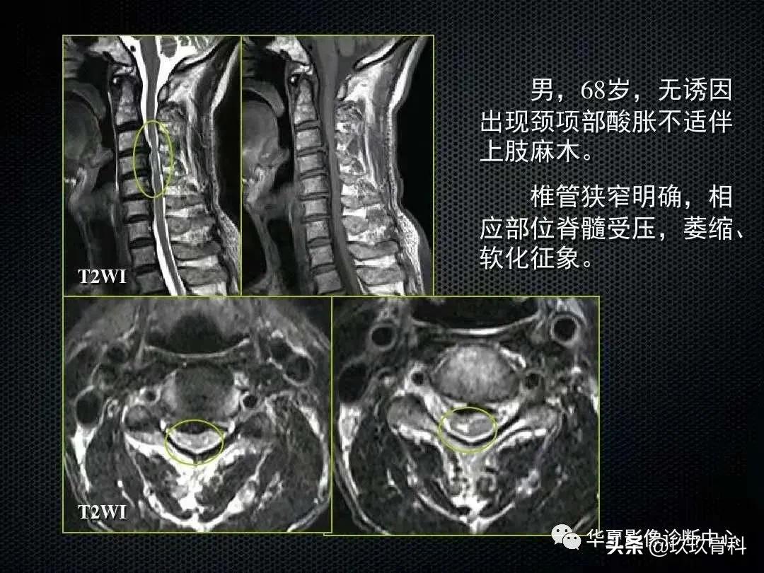 颈椎病脊髓变性mri表现,脊髓亚急性联合变性的诊断