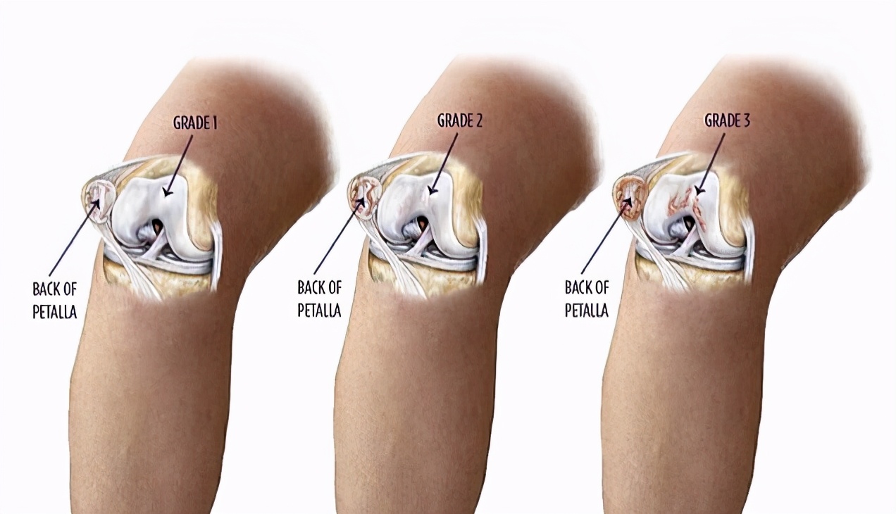 膝盖上楼发软无力但不疼痛怎么办,膝盖无力走楼梯发软是怎么回事