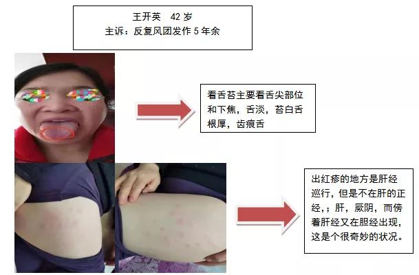 荨麻疹原因及中医治疗方法,荨麻疹中医如何根治