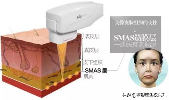 超声刀对皮肤有伤害吗,超声刀做的是哪一层的皮肤