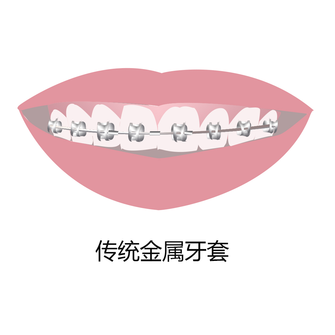 现在牙套有几种哪种好,牙套哪种最好