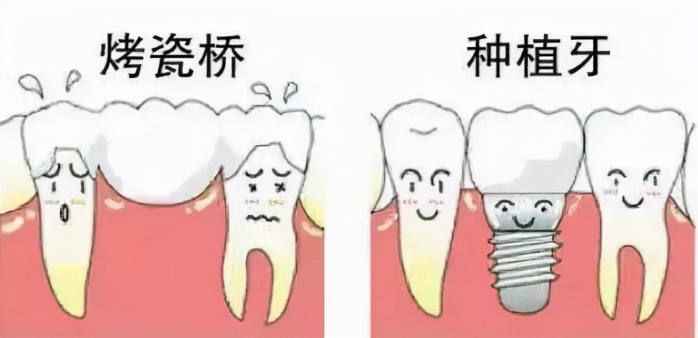 牙齿缝隙大做了烤瓷牙后悔了,烤瓷牙牙齿缺失又不想种牙怎么办