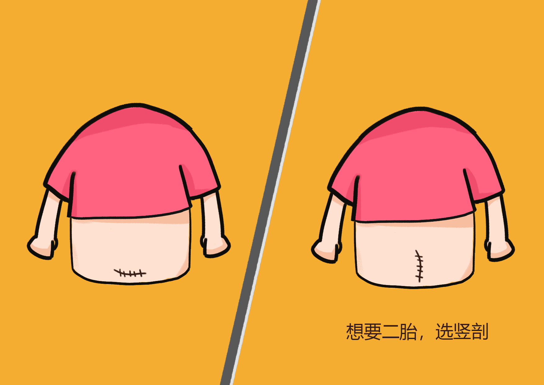 剖腹产术后粘连怎么解决,剖腹产后粘连是什么感觉