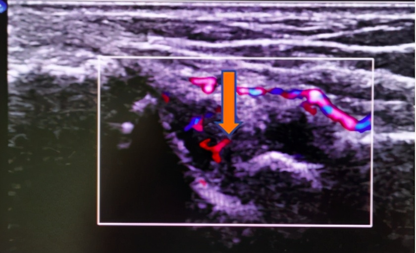 手腕疼痛需要拍片子吗,手腕肿痛ct可以查吗