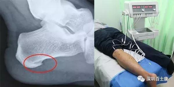 反复疼痛怎么治疗,为什么做了内热针还越来越疼