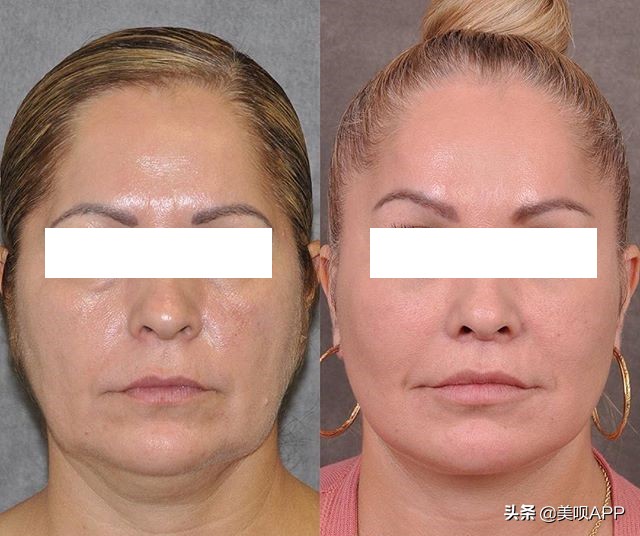 不做医美真的会快速衰老吗,为什么医美使得皮肤衰老更快