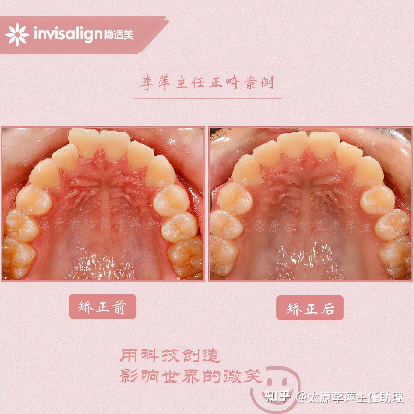 重度拥挤矫正牙齿适合隐形牙套吗,广州成人牙齿矫正推荐隐形牙套
