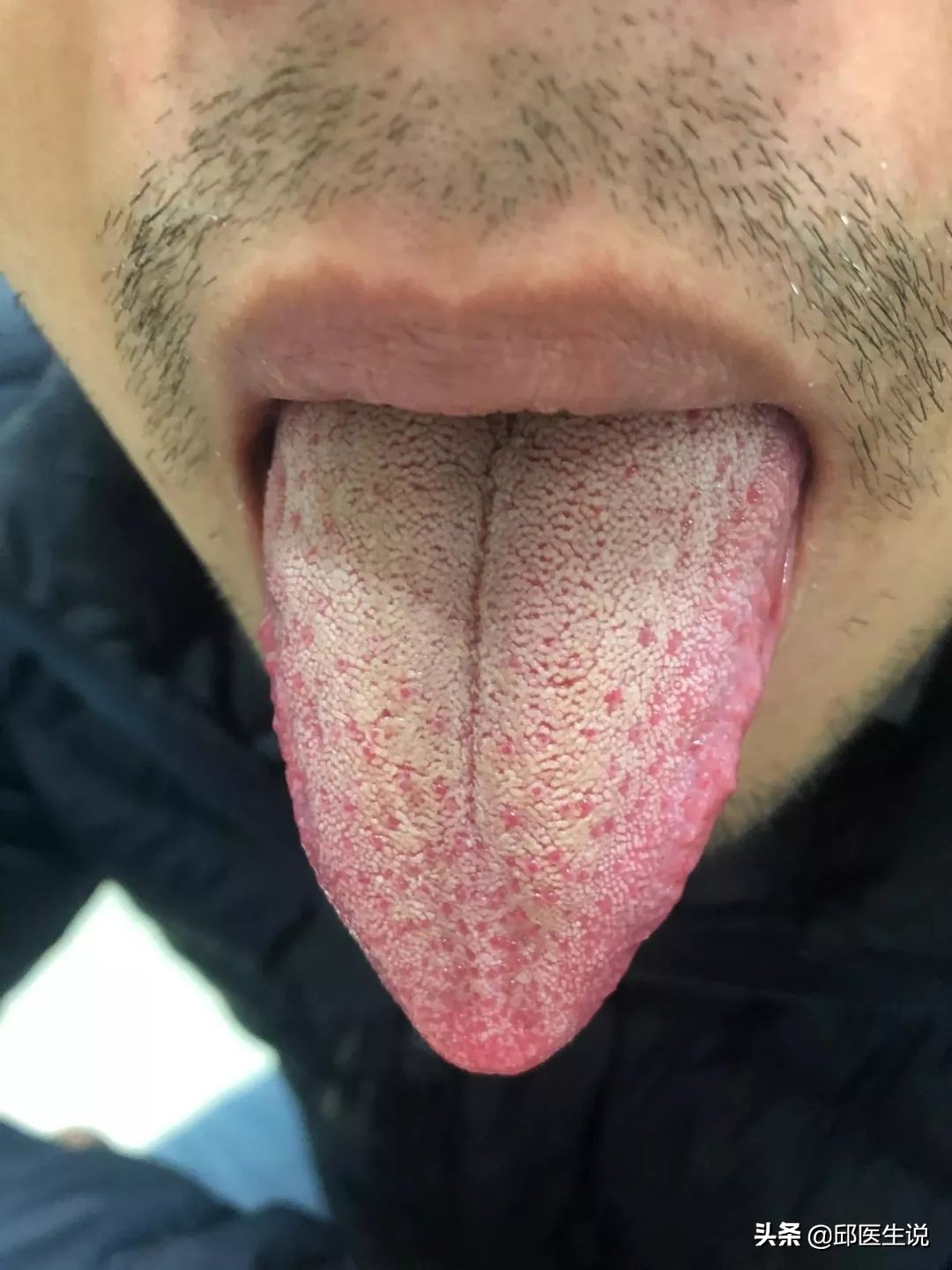 解决身体的湿气的偏方,本人湿气较重怎么能快速除湿气