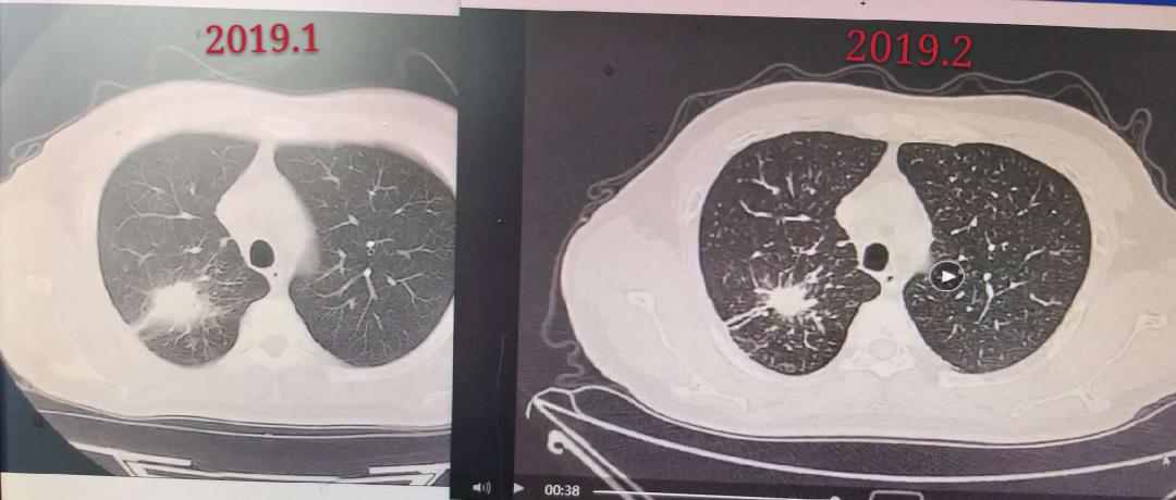 pd-1免疫治疗治愈案例,pd-1免疫治疗有效率是指什么