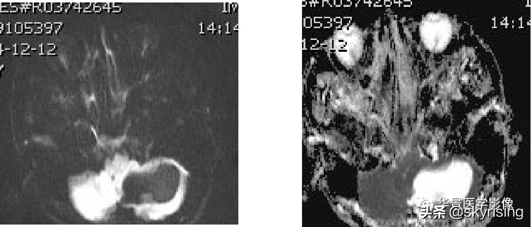 椎体侵袭性血管瘤mri影像学表现,中年妇女脑部血管海绵体瘤的症状