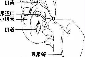 当女人膀胱、宫颈、直肠被癌症强行“打通”以后会是什么后果?