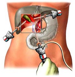 胆管放金属支架再次堵塞怎么办,胆管支架后反复发烧怎么办