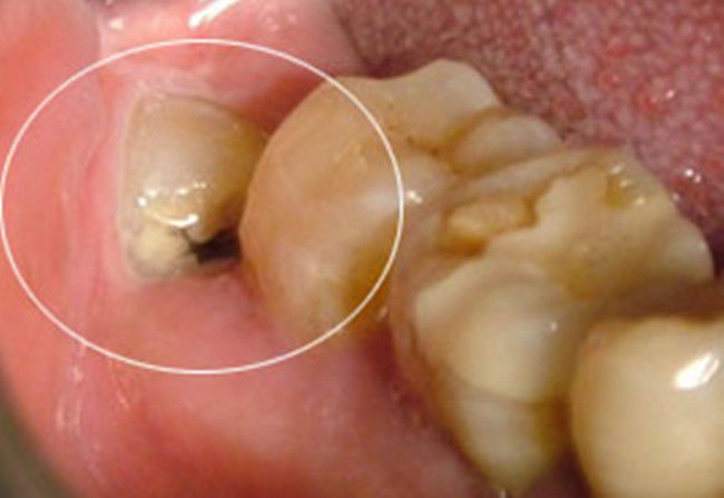 拔智齿会引起邻牙松动吗,拔智齿会导致其他牙齿松动吗