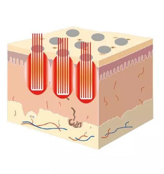 点阵激光祛痘印的副作用和危害,co2点阵激光危害
