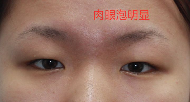 肿眼泡建议割双眼皮吗,肿眼泡做双眼皮怎样才会成功