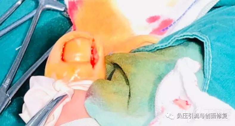 自己剪掉甲沟炎肉芽自己会消掉吗,甲沟炎拔甲后复发的几率多大