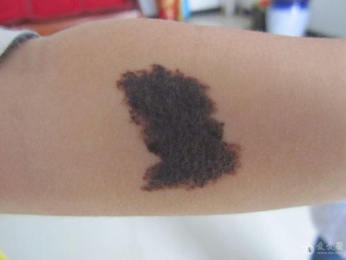 小儿色素沉着能消退吗,小孩子的色素痣着急处理吗