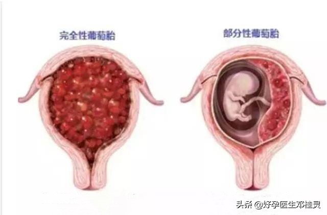 葡萄胎后一年半会怀上葡萄胎么,葡萄胎后还会怀上葡萄胎吗