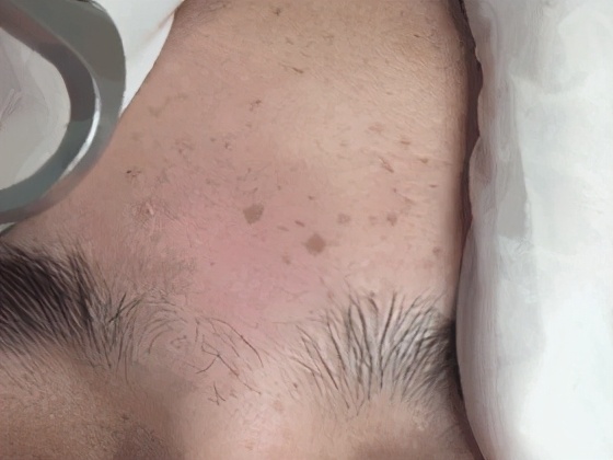 女人脸上有斑吃什么药可以祛斑,脸上长斑吃什么中药调理祛斑