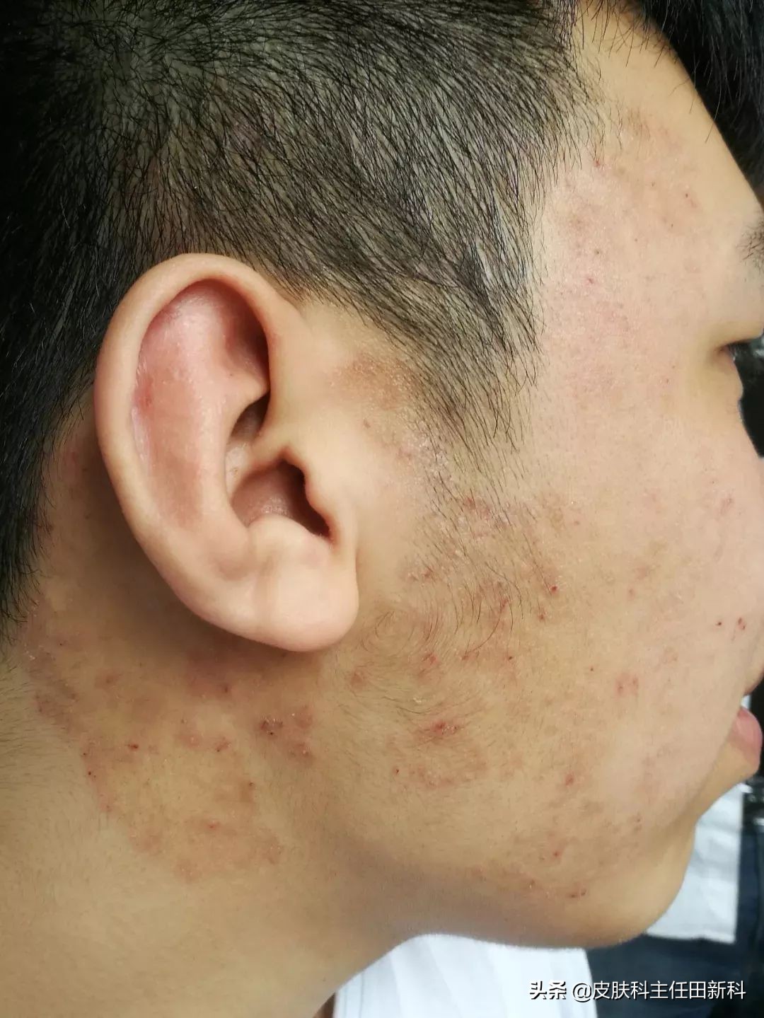 痘印变成斑点怎么治,痘印的种类以及成因你了解多少