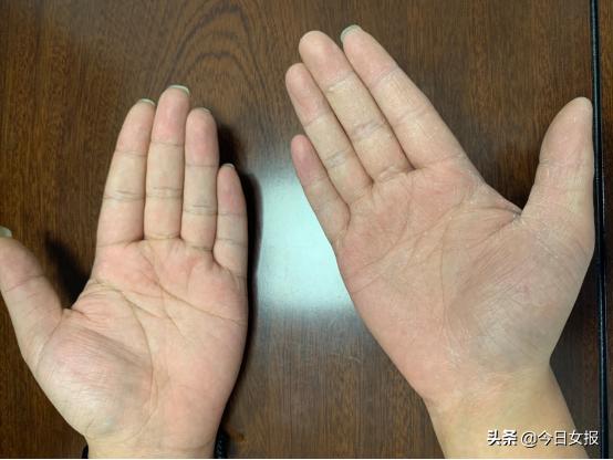 20岁男子双手脱皮还长了灰指甲，竟因爱抠脚的坏习惯！网友：细菌太厉害