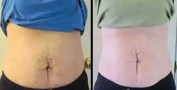 王妃产后被群嘲：肚子里还藏着一个？你所不知道的生育后遗症多可怕