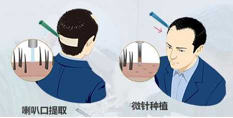 植发费用为何这么贵,植发怎么算费用