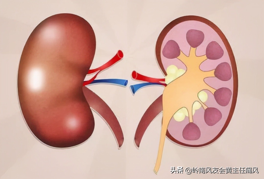 痛风和肌酐高注意事项,肌酐升高的原因痛风