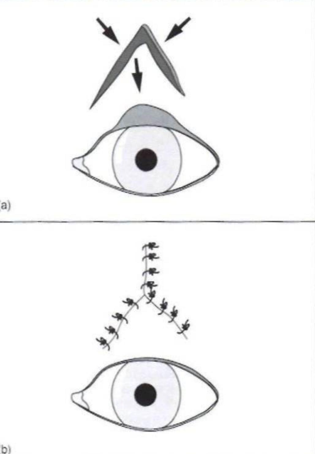 割双眼皮割反了,狗狗眼睑内翻手术