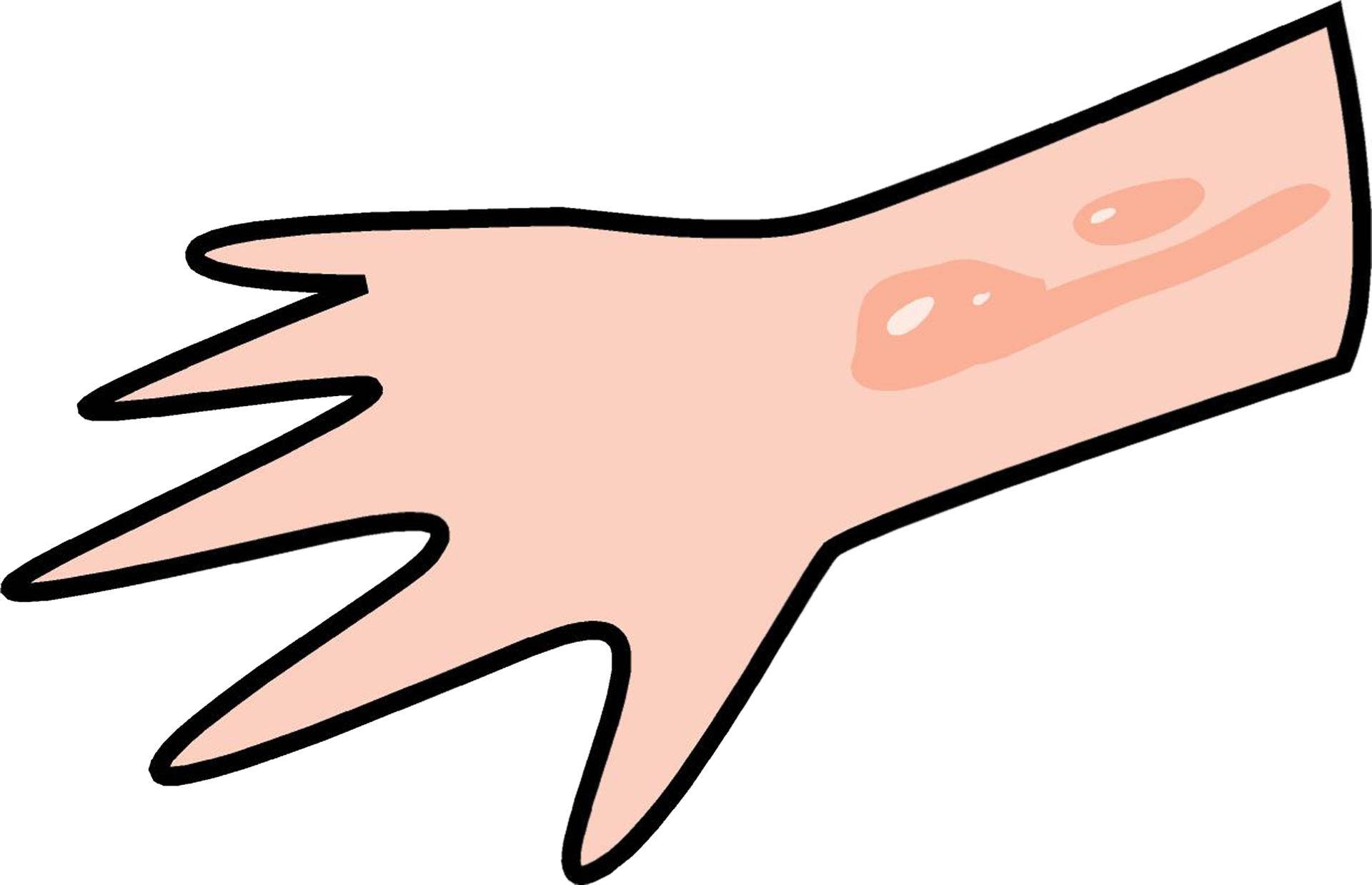 烫伤之后涂药怎么处理伤口,烫伤急救误区