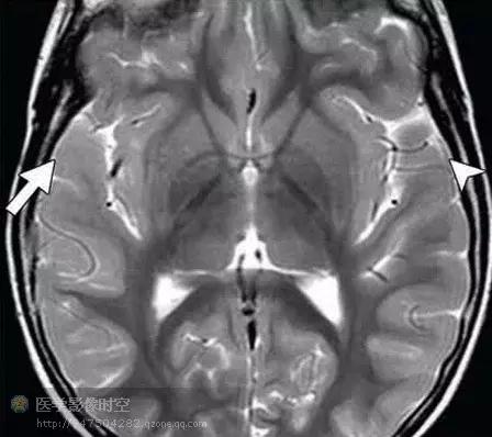 儿童癫痫CT表现,儿童各类癫痫脑电图特征