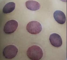 拔罐后为啥有的罐印有的深有的浅,拔罐对人是有好处还是有坏处