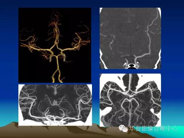 小脑血管解剖分段,脑血管影像解剖讲解