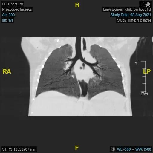 小孩肺炎支气管镜洗肺过程,肺炎总是不好怎么办