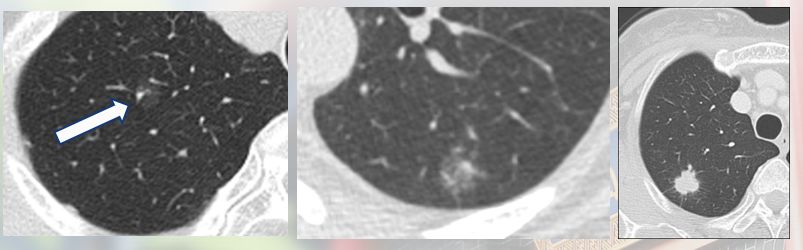 华西廖正银教授治肺结节,华西医院肺癌专家唐小军