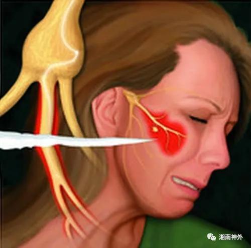 湘南学院附属医院罗忠平,湘雅神经外科罗忠平