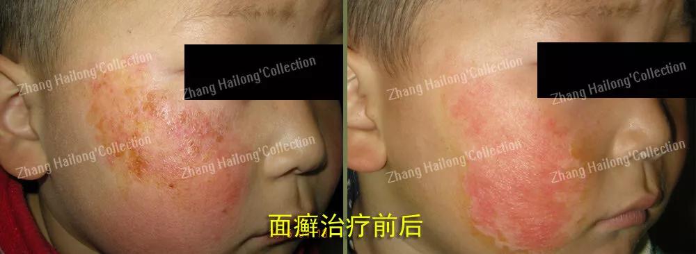 小狗脸上长癣怎么办,孩子脸上长癣是怎么回事啊