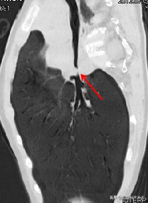 孩子支气管异物ct能查出吗,儿童支气管异物诊断方法